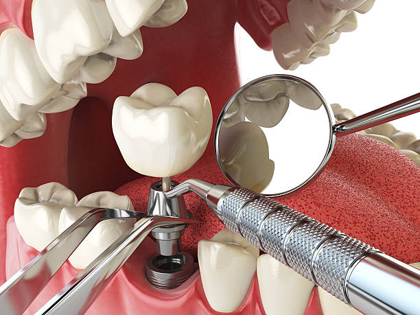 Best Broken or Chipped Tooth Repair in Shingle Springs, CA